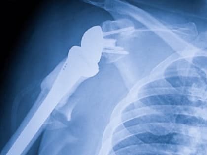 Нижегородец получил новый шанс на жизнь после серьезной травмы