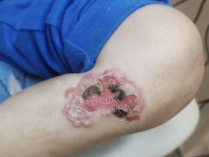 Редкий случай дерматита Дюринга зафиксирован в Нижнем Новгороде