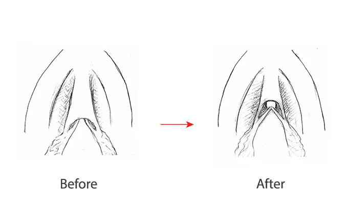 Clitoral Hood Reduction