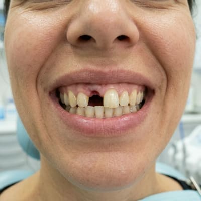 Before Dental Implants