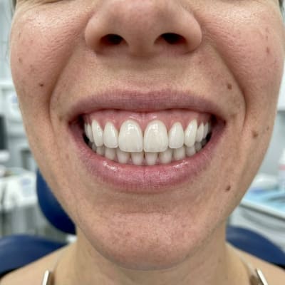 After Porcelain Veneers