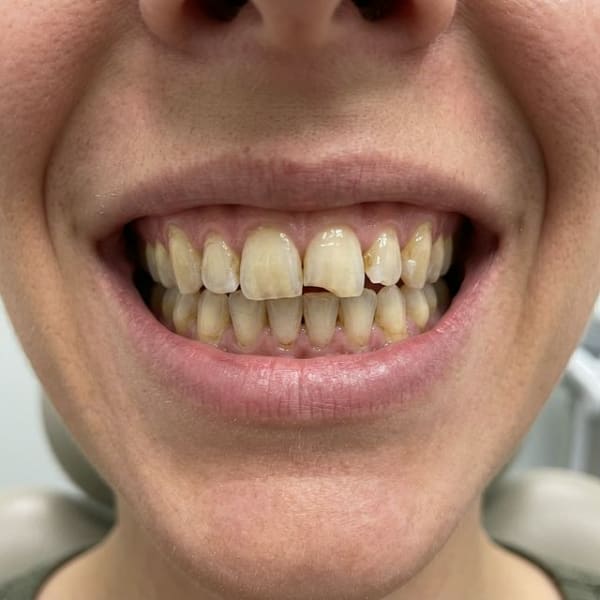 Before Porcelain Veneers