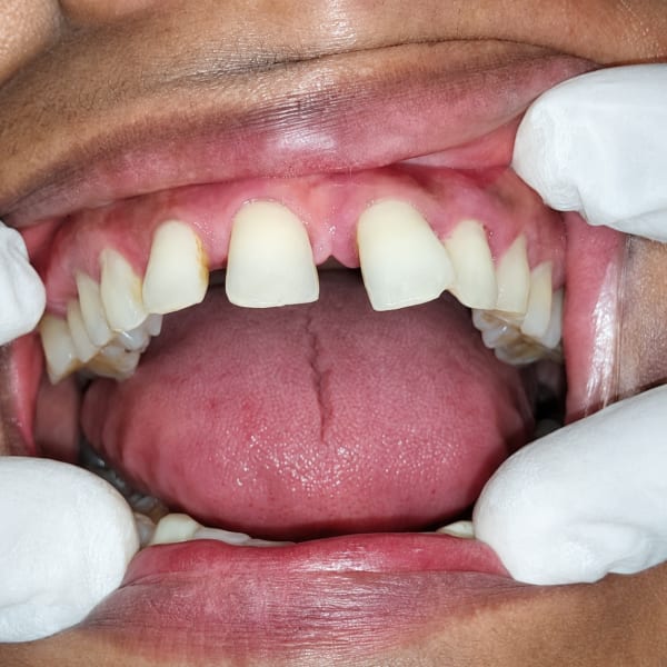 Before Clear Aligners (Invisalign)