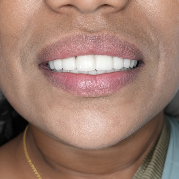 After Clear Aligners (Invisalign)