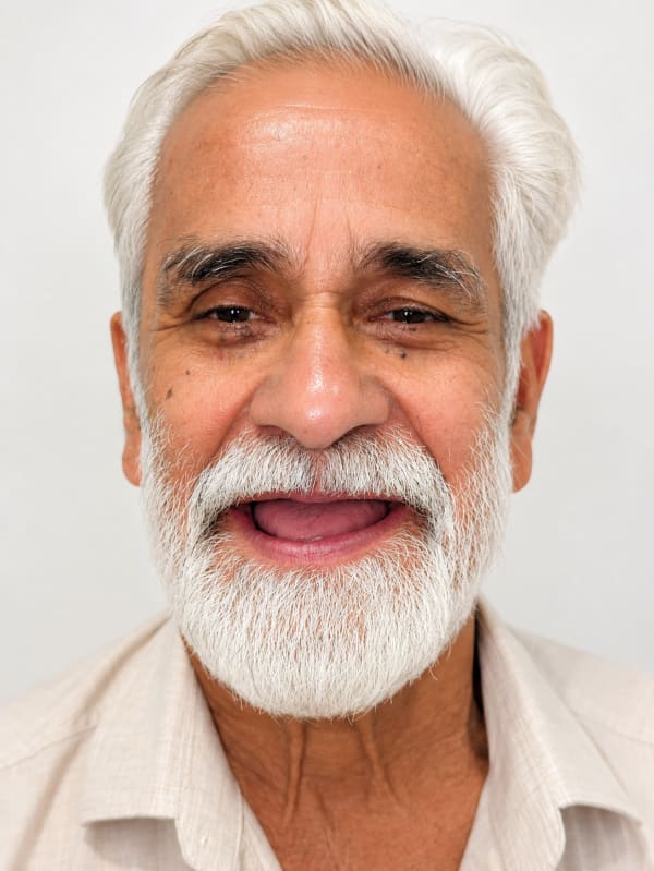 Before Porcelain Veneers