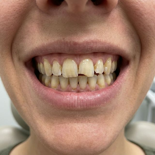 Before Porcelain Veneers