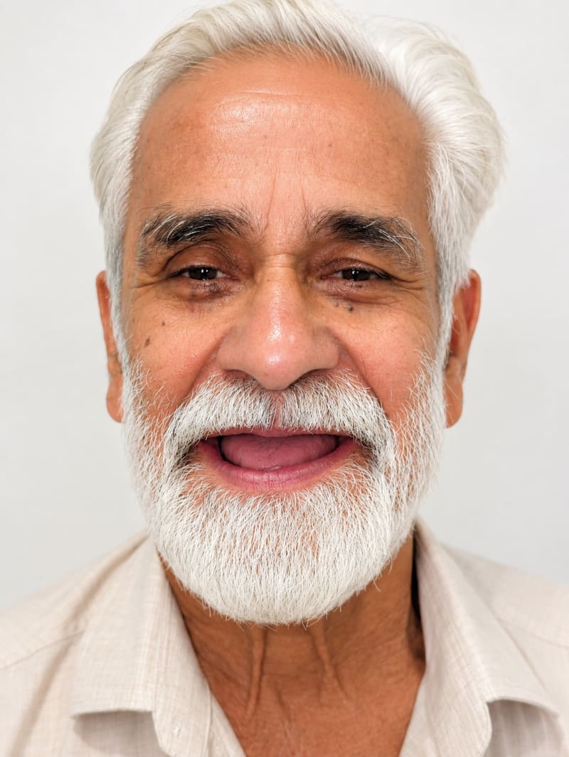 Before Full Mouth Rehabilitation