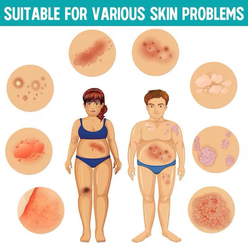 Psoriasis crème 3
