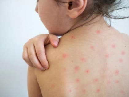 В Ростовской области более семи тысяч детей ожидают вакцину от кори