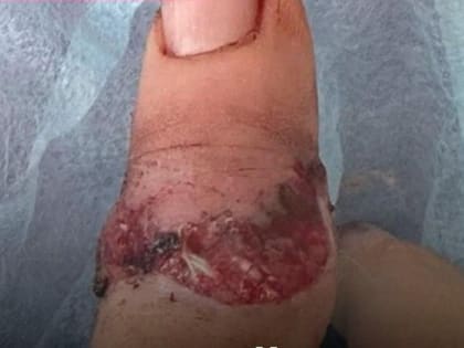 Врачи в Ростове пришили девочке палец, который она оторвала в школе