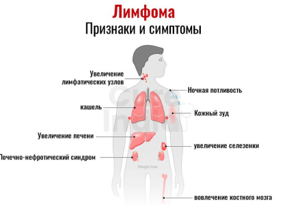 РОСТОВСКИЕ ОНКОЛОГИ НАЗВАЛИ ПЕРВЫЕ СИМПТОМЫ РАКА КРОВЕТВОРНОЙ И ЛИМФАТИЧЕСКОЙ СИСТЕМ