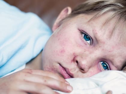 ОДИН ПАЦИЕНТ С ПОДОЗРЕНИЕМ: ВЛАСТИ ОПРОВЕРГЛИ СЛУХИ О ВСПЫШКЕ КОРИ В РОСТОВЕ