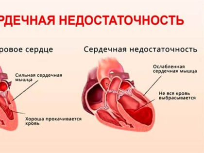 Кардиолог ОКДЦ рассказала, что приводит к хронической сердечной недостаточности