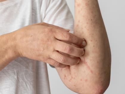 Детей от кори смогут привить в случае эпидемиологических показателей