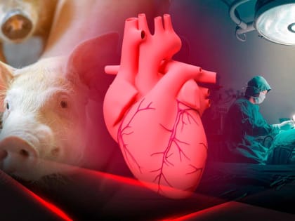 В США умер второй в мире пациент, которому пересадили сердце свиньи