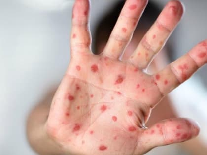 В Ростовской области выявили три случая энтеровирусной инфекции