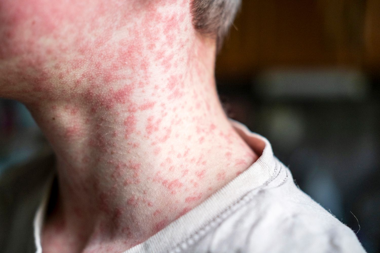 Pennsylvania Reports Fourth Measles Death in 2026 Amid State's Worst Outbreak in Decades thumbnail 3