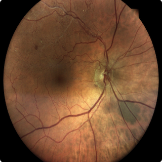 Hyperbaric Oxygen Treats Central Retinal Artery Occlusion