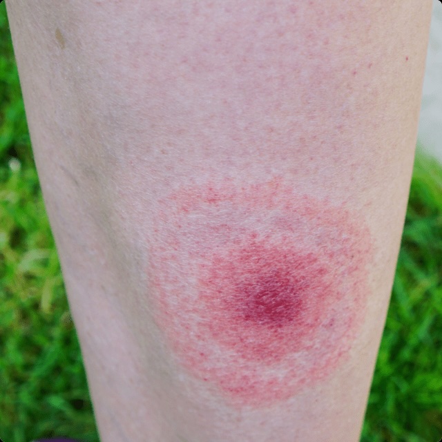 Lyme Disease