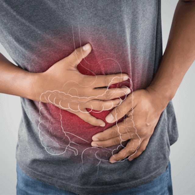 Ulcerative Colitis