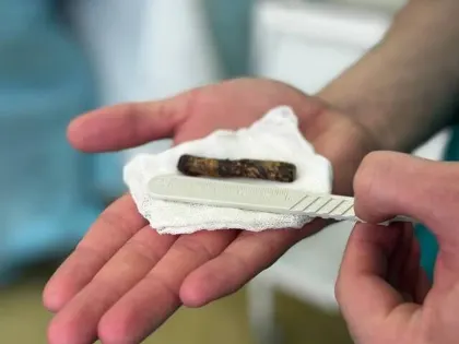 В Ижевске врачи извлекли осколок из ноги бойца, раненого при обстреле