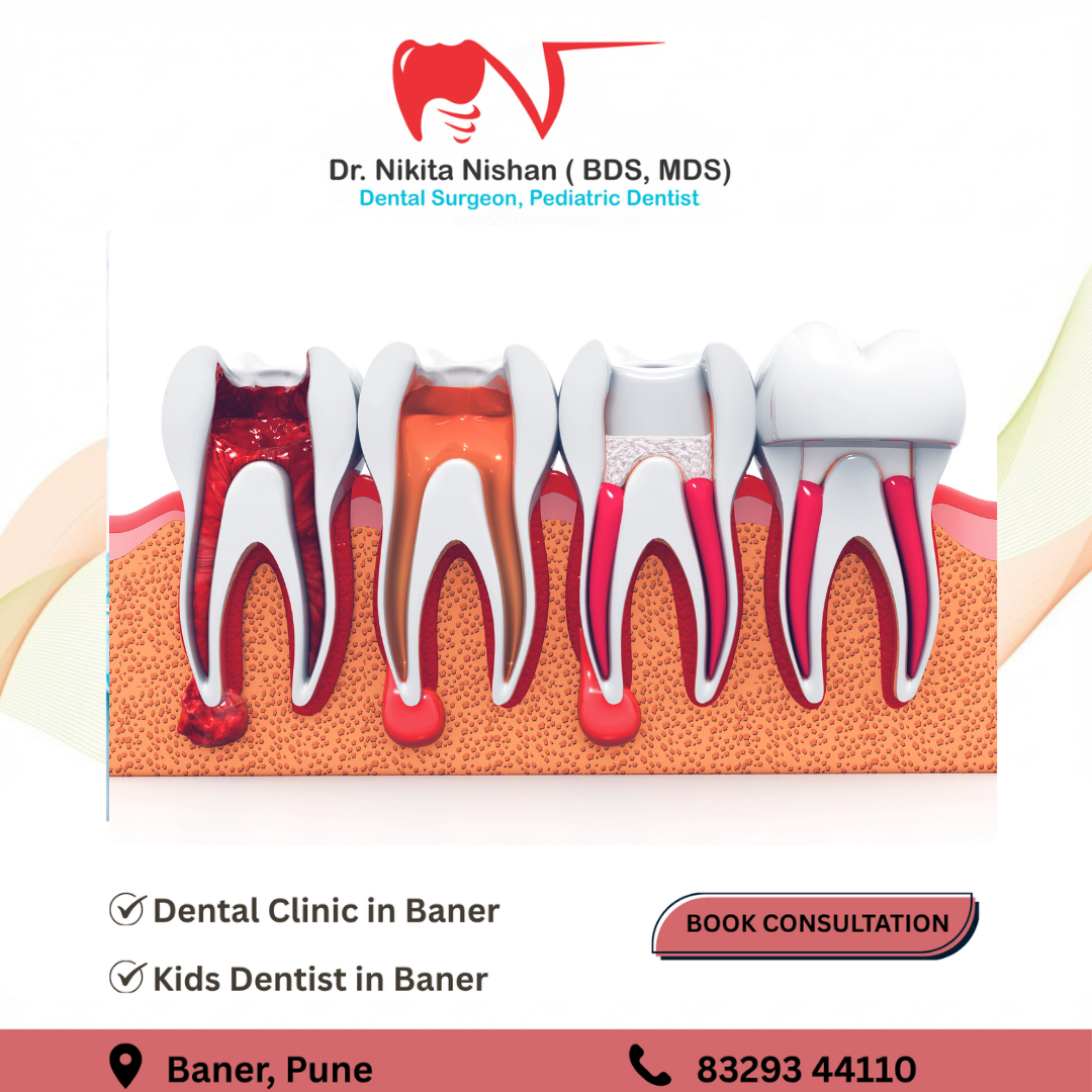 Root Canal Treatment in Baner – Signs You Shouldn’t Ignore
