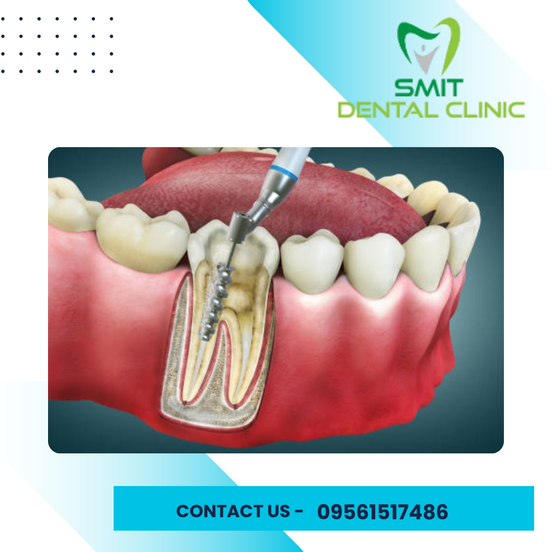 Root Canal Treatment – Saving Your Natural Teeth from Infection and Pain