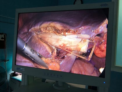 Житель Кировской области 10 лет прожил с 9-сантиметровым куском стекла в печени