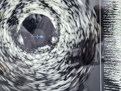 В Кирове начали применять внутрисосудистое ультразвуковое&nbsp;исследование