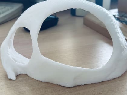 В Кирове спасли пациента, распечатав 3D-модель его черепа