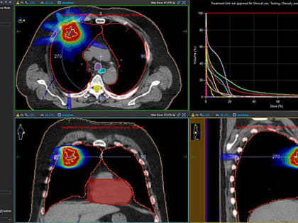 В Кирове внедрили инновационный метод лечения онкологии