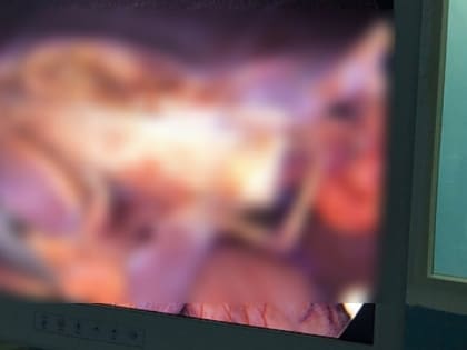 Кировские хирурги достали из мужчины огромный кусок стекла