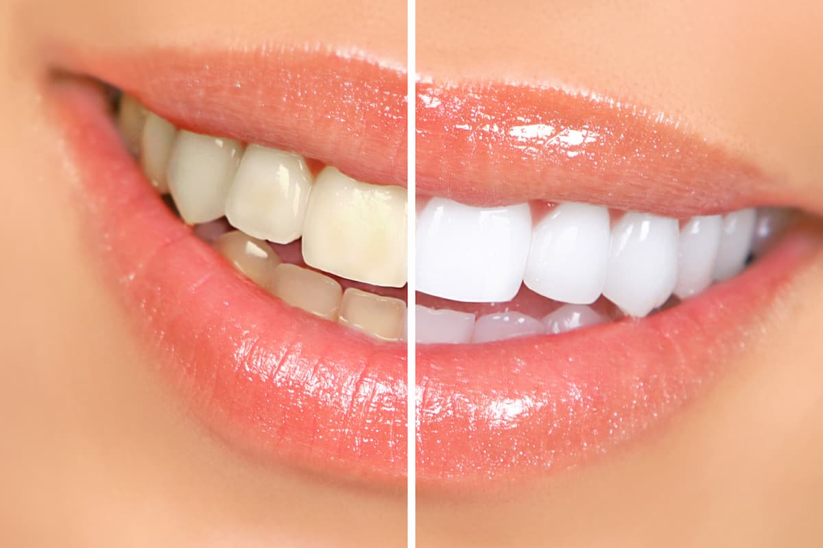 Teeth Whitening vs Veneers: Which Is Better for You?