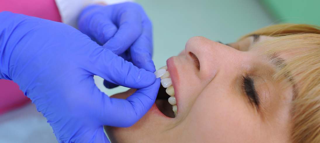 Why Food Gets Trapped Between Teeth and How to Prevent It