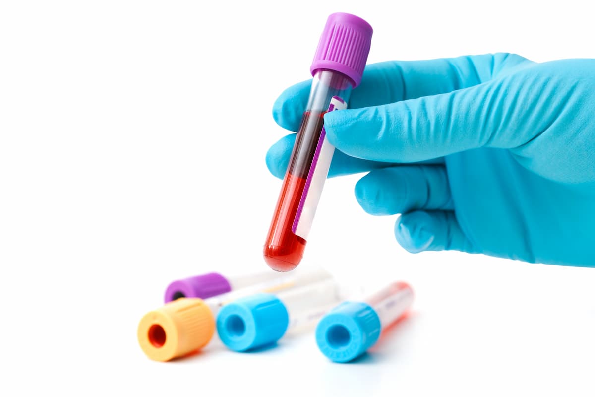 Uncovering Hidden Autoimmune Tendencies: Key ANA and Inflammatory Biomarkers to Monitor