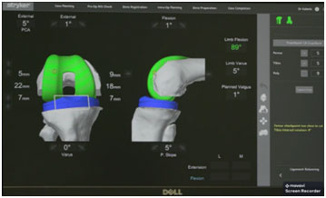 Knee Replacement