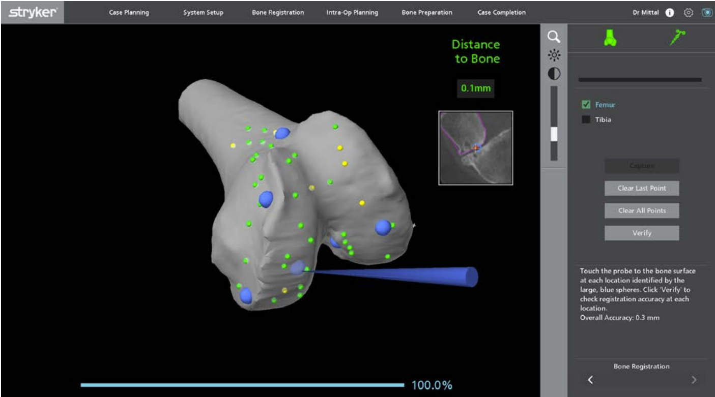 Bone Registration