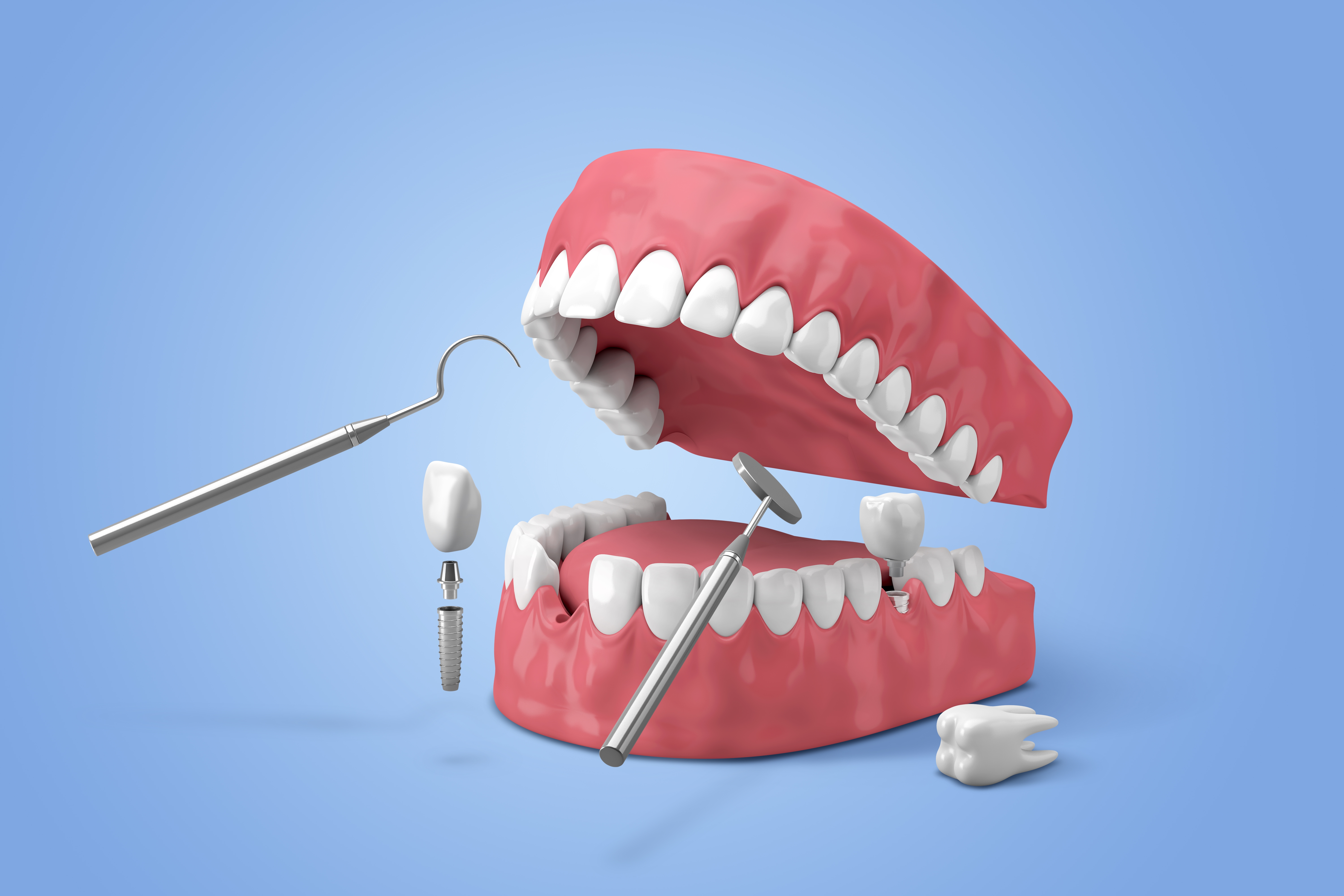 임플란트 구조와 치아 치료 도구를 보여주는 3D 일러스트 이미지