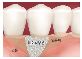 임플란트 시 뼈이식이 필요한 잇몸 구조를 보여주는 치과 설명 이미지