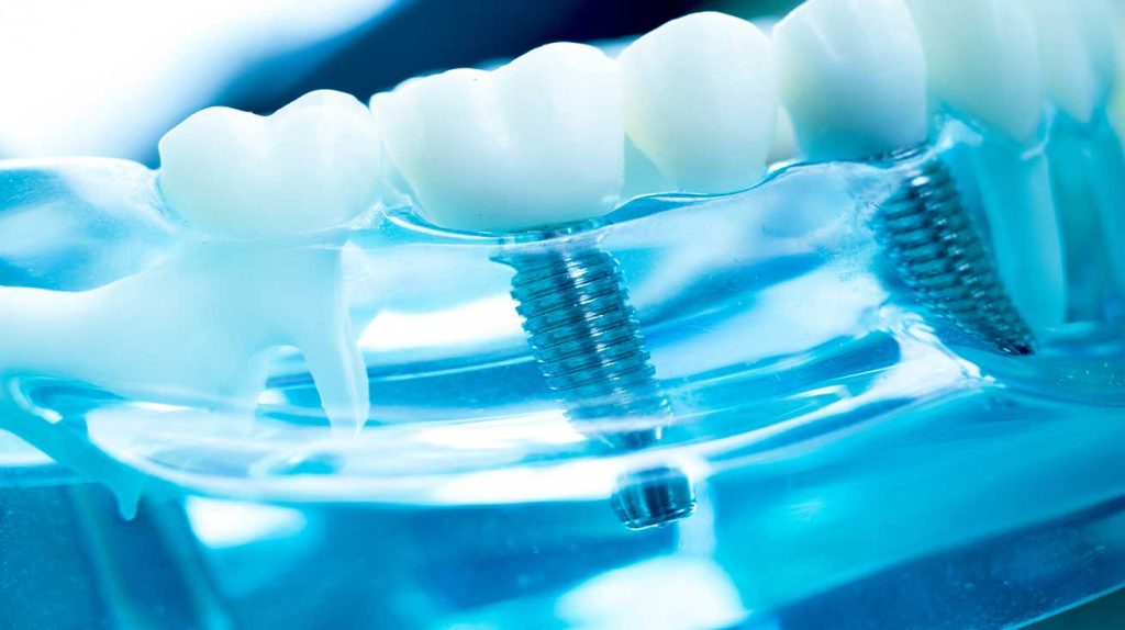 Dental implants alternatives