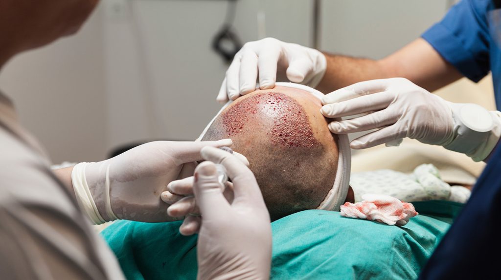 Transplantace vlasů : trvalé nebo dočasné výsledky ?