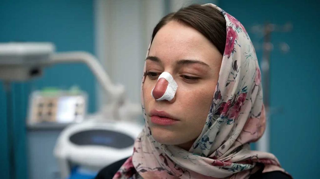 Rhinoplasty vs Rhinofiller : what’s the difference ?