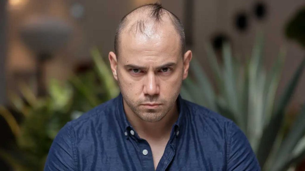 Kdy byste měli zvážit transplantaci vlasů ?