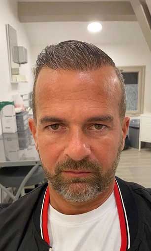 After Treatment