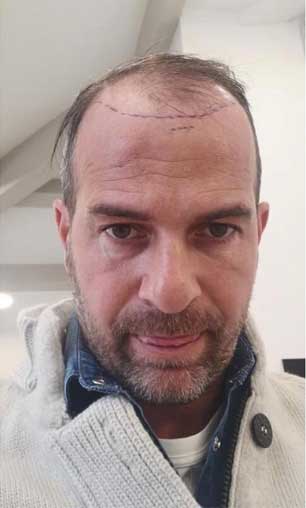 Before Treatment