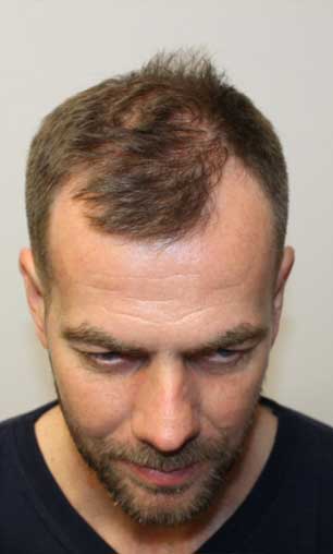 Before Treatment