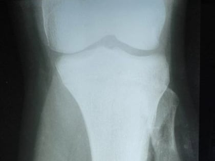 Донецкие врачи удалили подростку объемную опухоль кости