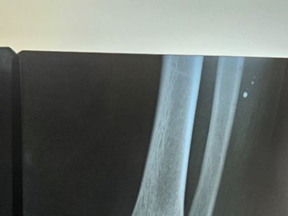 Донецкие хирурги успешно прооперировали подростка, пострадавшего от взрыва неизвестного предмета, сброшенного с БПЛА