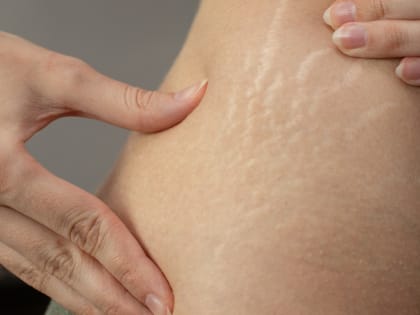 Дерматолог Филева назвала простые способы снизить риск появления растяжек на коже