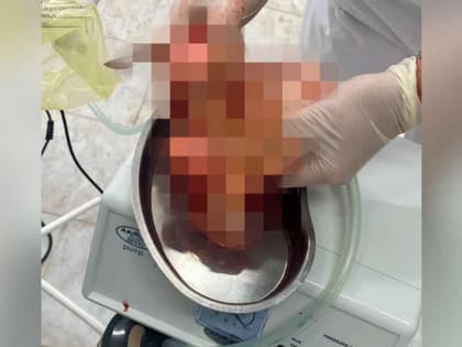 Уфимские врачи удалили девушке опухоль матки размером с 16-недельный плод